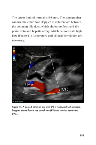 The upper limit of normal is 6-8 mm. The sonographer
can use the color ﬂow Doppler to diﬀerentiate between
the common bile duct, which shows no ﬂow, and the
portal vein and hepatic artery, which demonstrate high
ﬂow (Figure 11). Laboratory and clinical correlation are
necessary.




Figure 11. A dilated common bile duct (*) is measured with calipers.
Doppler shows ﬂow in the portal vein (PV) and inferior vena cava
(IVC).




                                                                   195
 