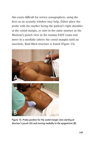 this exam diﬃcult for novice sonographers, using the
liver as an acoustic window may help. Either place the
probe with the marker facing the patient s right shoulder
at the costal margin, or start in the same manner as the
Morison s pouch view in the trauma FAST exam and
move in a medially (above the costal margin) until an
anechoic, ﬂuid ﬁlled structure is found (Figure 13).




Figure 13. Probe position for the costal margin view starting at
Morison’s pouch (A) and moving medially to the epigastrium (B)



                                                                   197
 