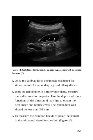 Figure 14. Gallstones (arrowheads) appear hyperechoic with anechoic
shadows (*)


7. Once the gallbladder is completely evaluated for
   stones, search for secondary signs of biliary disease.

8. With the gallbladder in a transverse plane, measure
   the wall closest to the probe. Use the depth and zoom
   functions of the ultrasound machine to obtain the
   best image and reduce error. The gallbladder wall
   should be less than 3-4 mm.

9. To measure the common bile duct, place the patient
   in the left lateral decubitus position (Figure 10).


                                                               201
 