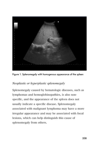 Figure 1. Splenomegaly with homogenous appearance of the spleen



Neoplastic or hyperplastic splenomegaly

Splenomegaly caused by hematologic diseases, such as
lymphomas and hemoglobinopathies, is also non-
speciﬁc, and the appearance of the spleen does not
usually indicate a speciﬁc disease. Splenomegaly
associated with malignant lymphoma may have a more
irregular appearance and may be associated with focal
lesions, which can help distinguish this cause of
splenomegaly from others.




                                                              208
 