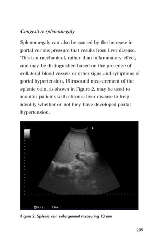 Congestive splenomegaly

Splenomegaly can also be caused by the increase in
portal venous pressure that results from liver disease.
This is a mechanical, rather than inﬂammatory eﬀect,
and may be distinguished based on the presence of
collateral blood vessels or other signs and symptoms of
portal hypertension. Ultrasound measurement of the
splenic vein, as shown in Figure 2, may be used to
monitor patients with chronic liver disease to help
identify whether or not they have developed portal
hypertension.




Figure 2. Splenic vein enlargement measuring 13 mm


                                                          209
 
