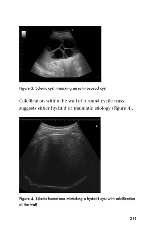 Figure 3. Splenic cyst mimicking an echinococcal cyst


Calciﬁcation within the wall of a round cystic mass
suggests either hydatid or traumatic etiology (Figure 4).




Figure 4. Splenic hematoma mimicking a hydatid cyst with calciﬁcation
of the wall


                                                                  211
 