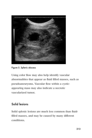 Figure 5. Splenic abscess


Using color ﬂow may also help identify vascular
abnormalities that appear as ﬂuid ﬁlled masses, such as
pseudoaneurysms. Vascular ﬂow within a cystic-
appearing mass may also indicate a necrotic
vascularized tumor.



Solid lesions

Solid splenic lesions are much less common than ﬂuid-
ﬁlled masses, and may be caused by many diﬀerent
conditions.


                                                     213
 