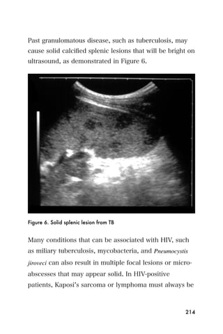 Past granulomatous disease, such as tuberculosis, may
cause solid calciﬁed splenic lesions that will be bright on
ultrasound, as demonstrated in Figure 6.




Figure 6. Solid splenic lesion from TB


Many conditions that can be associated with HIV, such
as miliary tuberculosis, mycobacteria, and Pneumocystis
jiroveci can also result in multiple focal lesions or micro-
abscesses that may appear solid. In HIV-positive
patients, Kaposi s sarcoma or lymphoma must always be



                                                         214
 