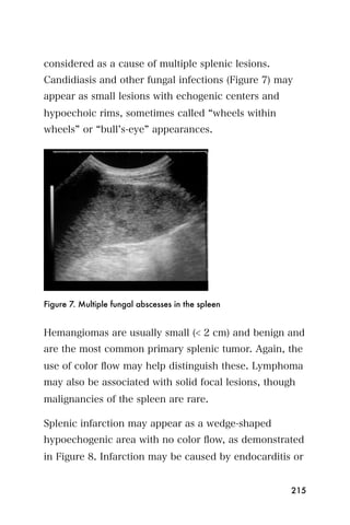 considered as a cause of multiple splenic lesions.
Candidiasis and other fungal infections (Figure 7) may
appear as small lesions with echogenic centers and
hypoechoic rims, sometimes called wheels within
wheels or bull s-eye appearances.




Figure 7. Multiple fungal abscesses in the spleen


Hemangiomas are usually small (< 2 cm) and benign and
are the most common primary splenic tumor. Again, the
use of color ﬂow may help distinguish these. Lymphoma
may also be associated with solid focal lesions, though
malignancies of the spleen are rare.

Splenic infarction may appear as a wedge-shaped
hypoechogenic area with no color ﬂow, as demonstrated
in Figure 8. Infarction may be caused by endocarditis or


                                                      215
 