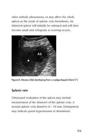 other embolic phenomena, or may aﬀect the whole
spleen as the result of splenic vein thrombosis. An
infarcted spleen will initially be enlarged and will then
become small and echogenic as scarring occurs.




Figure 8. Abscess (Ab) developing from a wedge-shaped infarct (*)




Splenic vein

Ultrasound evaluation of the spleen may include
measurement of the diameter of the splenic vein. A
normal splenic vein diameter is < 10 mm. Enlargement
may indicate portal hypertension or thrombosis.




                                                                216
 