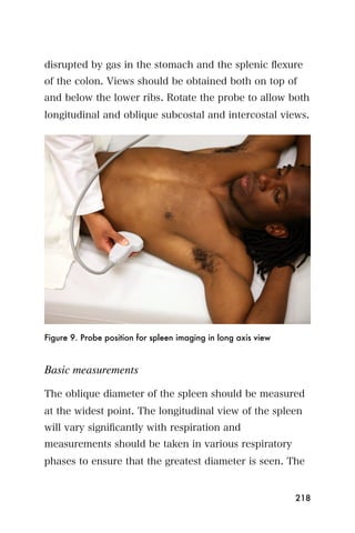 disrupted by gas in the stomach and the splenic ﬂexure
of the colon. Views should be obtained both on top of
and below the lower ribs. Rotate the probe to allow both
longitudinal and oblique subcostal and intercostal views.




Figure 9. Probe position for spleen imaging in long axis view



Basic measurements

The oblique diameter of the spleen should be measured
at the widest point. The longitudinal view of the spleen
will vary signiﬁcantly with respiration and
measurements should be taken in various respiratory
phases to ensure that the greatest diameter is seen. The


                                                                218
 