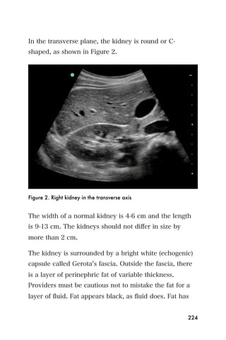 In the transverse plane, the kidney is round or C-
shaped, as shown in Figure 2.




Figure 2. Right kidney in the transverse axis


The width of a normal kidney is 4-6 cm and the length
is 9-13 cm. The kidneys should not diﬀer in size by
more than 2 cm.

The kidney is surrounded by a bright white (echogenic)
capsule called Gerota s fascia. Outside the fascia, there
is a layer of perinephric fat of variable thickness.
Providers must be cautious not to mistake the fat for a
layer of ﬂuid. Fat appears black, as ﬂuid does. Fat has


                                                       224
 