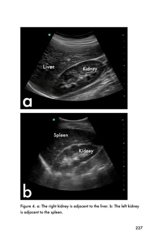 Figure 4. a: The right kidney is adjacent to the liver. b: The left kidney
is adjacent to the spleen.



                                                                       227
 