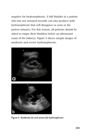 negative for hydronephrosis. A full bladder in a patient
who has not urinated recently can also produce mild
hydronephrosis that will disappear as soon as the
patient urinates. For this reason, all patients should be
asked to empty their bladders before an ultrasound
exam of the kidneys. Figure 5 shows sample images of
moderate and severe hydronephrosis.




Figure 5. Moderate (a) and severe (b) hydronephrosis



                                                        230
 