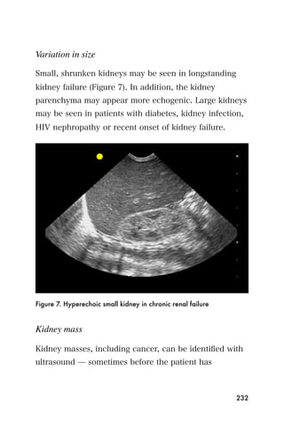 Variation in size

Small, shrunken kidneys may be seen in longstanding
kidney failure (Figure 7). In addition, the kidney
parenchyma may appear more echogenic. Large kidneys
may be seen in patients with diabetes, kidney infection,
HIV nephropathy or recent onset of kidney failure.




Figure 7. Hyperechoic small kidney in chronic renal failure


Kidney mass

Kidney masses, including cancer, can be identiﬁed with
ultrasound ̶ sometimes before the patient has



                                                              232
 