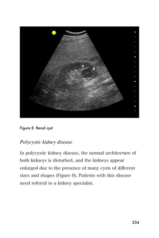 Figure 8. Renal cyst


Polycystic kidney disease

In polycystic kidney disease, the normal architecture of
both kidneys is disturbed, and the kidneys appear
enlarged due to the presence of many cysts of diﬀerent
sizes and shapes (Figure 9). Patients with this disease
need referral to a kidney specialist.




                                                          234
 