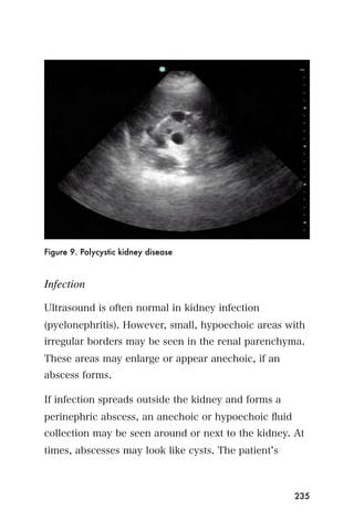 Figure 9. Polycystic kidney disease



Infection

Ultrasound is often normal in kidney infection
(pyelonephritis). However, small, hypoechoic areas with
irregular borders may be seen in the renal parenchyma.
These areas may enlarge or appear anechoic, if an
abscess forms.

If infection spreads outside the kidney and forms a
perinephric abscess, an anechoic or hypoechoic ﬂuid
collection may be seen around or next to the kidney. At
times, abscesses may look like cysts. The patient s



                                                      235
 