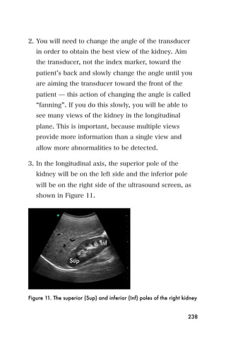 2. You will need to change the angle of the transducer
   in order to obtain the best view of the kidney. Aim
   the transducer, not the index marker, toward the
   patient s back and slowly change the angle until you
   are aiming the transducer toward the front of the
   patient ̶ this action of changing the angle is called
    fanning . If you do this slowly, you will be able to
   see many views of the kidney in the longitudinal
   plane. This is important, because multiple views
   provide more information than a single view and
   allow more abnormalities to be detected.

3. In the longitudinal axis, the superior pole of the
   kidney will be on the left side and the inferior pole
   will be on the right side of the ultrasound screen, as
   shown in Figure 11.




Figure 11. The superior (Sup) and inferior (Inf) poles of the right kidney


                                                                      238
 