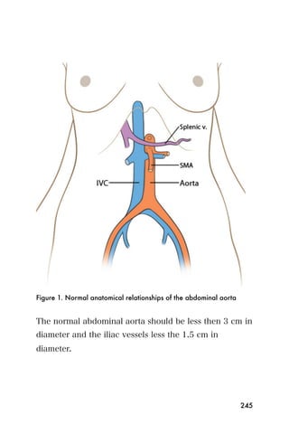 Figure 1. Normal anatomical relationships of the abdominal aorta


The normal abdominal aorta should be less then 3 cm in
diameter and the iliac vessels less the 1.5 cm in
diameter.




                                                                   245
 
