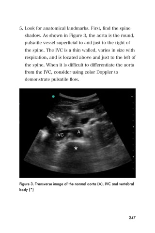 5. Look for anatomical landmarks. First, ﬁnd the spine
   shadow. As shown in Figure 3, the aorta is the round,
   pulsatile vessel superﬁcial to and just to the right of
   the spine. The IVC is a thin walled, varies in size with
   respiration, and is located above and just to the left of
   the spine. When it is diﬃcult to diﬀerentiate the aorta
   from the IVC, consider using color Doppler to
   demonstrate pulsatile ﬂow.




Figure 3. Transverse image of the normal aorta (A), IVC and vertebral
body (*)




                                                                  247
 