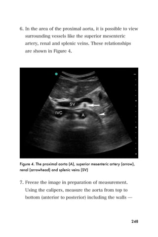6. In the area of the proximal aorta, it is possible to view
   surrounding vessels like the superior mesenteric
   artery, renal and splenic veins. These relationships
   are shown in Figure 4.




Figure 4. The proximal aorta (A), superior mesenteric artery (arrow),
renal (arrowhead) and splenic veins (SV)


7. Freeze the image in preparation of measurement.
   Using the calipers, measure the aorta from top to
   bottom (anterior to posterior) including the walls ̶




                                                                   248
 