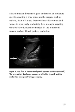 allow ultrasound beams to pass and reﬂect at moderate
speeds, creating a gray image on the screen, such as
muscle, liver or kidney. Some tissues allow ultrasound
waves to pass easily and retain their strength, creating
dark black or hypoechoic images on the ultrasound
screen, such as blood, ascites, and urine.




Figure 3. Free ﬂuid in hepato-renal pouch appears black (arrowheads).
The hyperechoic diaphragm appears bright white (arrow), and the
moderately echogenic liver appears gray.




                                                                  25
 