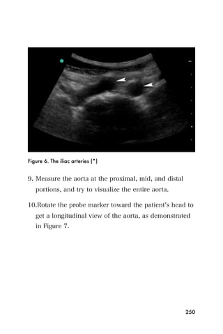Figure 6. The iliac arteries (*)


9. Measure the aorta at the proximal, mid, and distal
   portions, and try to visualize the entire aorta.

10.Rotate the probe marker toward the patient s head to
   get a longitudinal view of the aorta, as demonstrated
   in Figure 7.




                                                        250
 