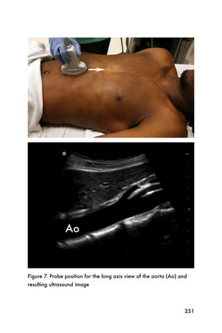 Figure 7. Probe position for the long axis view of the aorta (Ao) and
resulting ultrasound image




                                                                    251
 