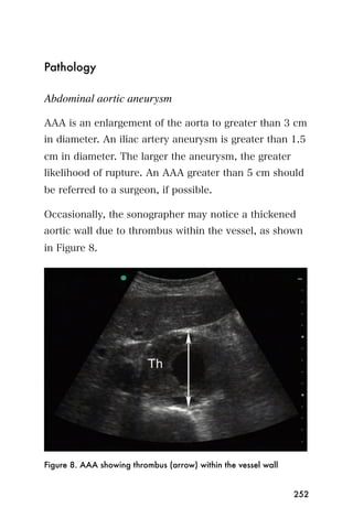 Pathology

Abdominal aortic aneurysm

AAA is an enlargement of the aorta to greater than 3 cm
in diameter. An iliac artery aneurysm is greater than 1.5
cm in diameter. The larger the aneurysm, the greater
likelihood of rupture. An AAA greater than 5 cm should
be referred to a surgeon, if possible.

Occasionally, the sonographer may notice a thickened
aortic wall due to thrombus within the vessel, as shown
in Figure 8.




Figure 8. AAA showing thrombus (arrow) within the vessel wall


                                                                252
 