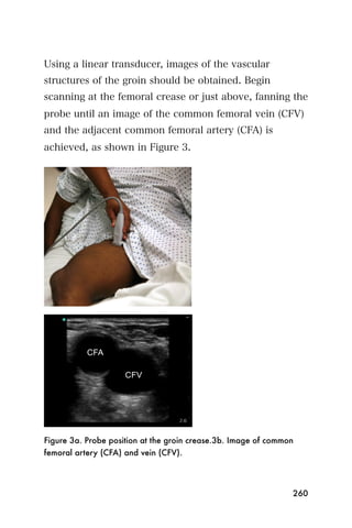 Using a linear transducer, images of the vascular
structures of the groin should be obtained. Begin
scanning at the femoral crease or just above, fanning the
probe until an image of the common femoral vein (CFV)
and the adjacent common femoral artery (CFA) is
achieved, as shown in Figure 3.




Figure 3a. Probe position at the groin crease.3b. Image of common
femoral artery (CFA) and vein (CFV).




                                                                260
 