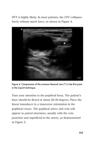DVT is highly likely. In most patients, the CFV collapses
freely without much force, as shown in Figure 4.




Figure 4. Compression of the common femoral vein (*) is the ﬁrst point
in the 2-point technique.


Turn your attention to the popliteal fossa. The patient s
knee should be ﬂexed at about 20-30 degrees. Place the
linear transducer in a transverse orientation in the
popliteal crease. The popliteal artery and vein will
appear as paired structures, usually with the vein
posterior and superﬁcial to the artery, as demonstrated
in Figure 5.


                                                                  262
 