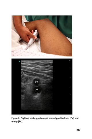 Figure 5. Popliteal probe position and normal popliteal vein (PV) and
artery (PA).


                                                                   263
 