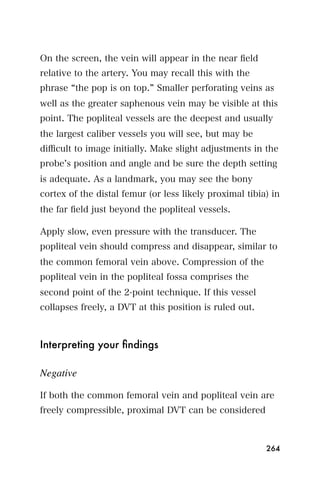 On the screen, the vein will appear in the near ﬁeld
relative to the artery. You may recall this with the
phrase the pop is on top. Smaller perforating veins as
well as the greater saphenous vein may be visible at this
point. The popliteal vessels are the deepest and usually
the largest caliber vessels you will see, but may be
diﬃcult to image initially. Make slight adjustments in the
probe s position and angle and be sure the depth setting
is adequate. As a landmark, you may see the bony
cortex of the distal femur (or less likely proximal tibia) in
the far ﬁeld just beyond the popliteal vessels.

Apply slow, even pressure with the transducer. The
popliteal vein should compress and disappear, similar to
the common femoral vein above. Compression of the
popliteal vein in the popliteal fossa comprises the
second point of the 2-point technique. If this vessel
collapses freely, a DVT at this position is ruled out.



Interpreting your ﬁndings

Negative

If both the common femoral vein and popliteal vein are
freely compressible, proximal DVT can be considered



                                                         264
 