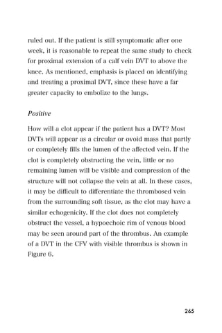 ruled out. If the patient is still symptomatic after one
week, it is reasonable to repeat the same study to check
for proximal extension of a calf vein DVT to above the
knee. As mentioned, emphasis is placed on identifying
and treating a proximal DVT, since these have a far
greater capacity to embolize to the lungs.


Positive

How will a clot appear if the patient has a DVT? Most
DVTs will appear as a circular or ovoid mass that partly
or completely ﬁlls the lumen of the aﬀected vein. If the
clot is completely obstructing the vein, little or no
remaining lumen will be visible and compression of the
structure will not collapse the vein at all. In these cases,
it may be diﬃcult to diﬀerentiate the thrombosed vein
from the surrounding soft tissue, as the clot may have a
similar echogenicity. If the clot does not completely
obstruct the vessel, a hypoechoic rim of venous blood
may be seen around part of the thrombus. An example
of a DVT in the CFV with visible thrombus is shown in
Figure 6.




                                                           265
 