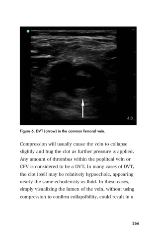 Figure 6. DVT (arrow) in the common femoral vein.


Compression will usually cause the vein to collapse
slightly and hug the clot as further pressure is applied.
Any amount of thrombus within the popliteal vein or
CFV is considered to be a DVT. In many cases of DVT,
the clot itself may be relatively hypoechoic, appearing
nearly the same echodensity as ﬂuid. In these cases,
simply visualizing the lumen of the vein, without using
compression to conﬁrm collapsibility, could result in a




                                                        266
 