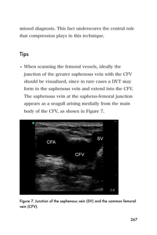 missed diagnosis. This fact underscores the central role
that compression plays in this technique.



Tips

• When scanning the femoral vessels, ideally the
  junction of the greater saphenous vein with the CFV
  should be visualized, since in rare cases a DVT may
  form in the saphenous vein and extend into the CFV.
  The saphenous vein at the sapheno-femoral junction
  appears as a seagull arising medially from the main
  body of the CFV, as shown in Figure 7.




Figure 7. Junction of the saphenous vein (SV) and the common femoral
vein (CFV).


                                                                267
 