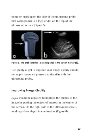 bump or marking on the side of the ultrasound probe
that corresponds to a logo or dot on the top of the
ultrasound screen (Figure 5).




Figure 5. The probe marker (a) corresponds to the screen marker (b).


Use plenty of gel to improve your image quality and do
not apply too much pressure to the skin with the
ultrasound probe.



Improving Image Quality

Depth should be adjusted to improve the quality of the
image by putting the object of interest in the center of
the screen. On the right side of the ultrasound screen,
markings show depth in centimeters (Figure 6).




                                                                   27
 