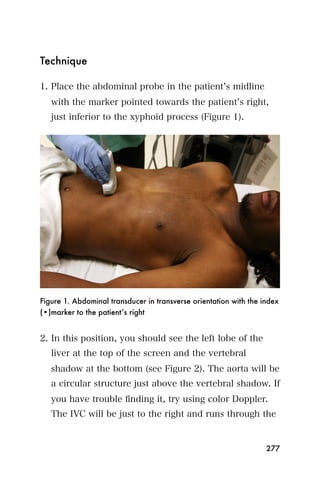 Technique

1. Place the abdominal probe in the patient s midline
   with the marker pointed towards the patient s right,
   just inferior to the xyphoid process (Figure 1).




Figure 1. Abdominal transducer in transverse orientation with the index
(•)marker to the patient’s right


2. In this position, you should see the left lobe of the
   liver at the top of the screen and the vertebral
   shadow at the bottom (see Figure 2). The aorta will be
   a circular structure just above the vertebral shadow. If
   you have trouble ﬁnding it, try using color Doppler.
   The IVC will be just to the right and runs through the


                                                                   277
 