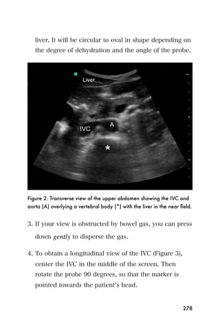 liver. It will be circular to oval in shape depending on
   the degree of dehydration and the angle of the probe.




Figure 2. Transverse view of the upper abdomen showing the IVC and
aorta (A) overlying a vertebral body (*) with the liver in the near ﬁeld.


3. If your view is obstructed by bowel gas, you can press

   down gently to disperse the gas.

4. To obtain a longitudinal view of the IVC (Figure 3),
   center the IVC in the middle of the screen. Then
   rotate the probe 90 degrees, so that the marker is
   pointed towards the patient s head.


                                                                     278
 