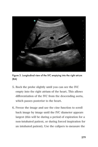 Figure 3. Longitudinal view of the IVC emptying into the right atrium
(RA)


5. Rock the probe slightly until you can see the IVC
   empty into the right atrium of the heart. This allows
   diﬀerentiation of the IVC from the descending aorta,
   which passes posterior to the heart.

6. Freeze the image and use the cine function to scroll
   back image by image until the IVC diameter appears
   largest (this will be during a period of expiration for a
   non-intubated patient, or during forced inspiration for
   an intubated patient). Use the calipers to measure the



                                                                    279
 