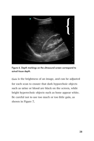Figure 6. Depth markings on the ultrasound screen correspond to
actual tissue depth.


Gain is the brightness of an image, and can be adjusted
for each scan to ensure that dark hypoechoic objects
such as urine or blood are black on the screen, while
bright hyperechoic objects such as bone appear white.
Be careful not to use too much or too little gain, as
shown in Figure 7.




                                                                  28
 