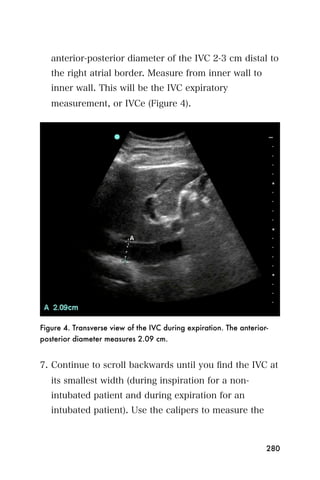 anterior-posterior diameter of the IVC 2-3 cm distal to
   the right atrial border. Measure from inner wall to
   inner wall. This will be the IVC expiratory
   measurement, or IVCe (Figure 4).




Figure 4. Transverse view of the IVC during expiration. The anterior-
posterior diameter measures 2.09 cm.


7. Continue to scroll backwards until you ﬁnd the IVC at
   its smallest width (during inspiration for a non-
   intubated patient and during expiration for an
   intubated patient). Use the calipers to measure the



                                                                    280
 
