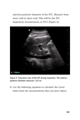 anterior-posterior diameter of the IVC. Measure from
   inner wall to inner wall. This will be the IVC-
   inspiratory measurement, or IVCi (Figure 5).




Figure 5. Transverse view of the IVC during inspiration. The anterior-
posterior diameter measures 1.35 cm.


8. Use the following equation to calculate the Caval
   Index from the measurements that you have taken:




                                                                     281
 