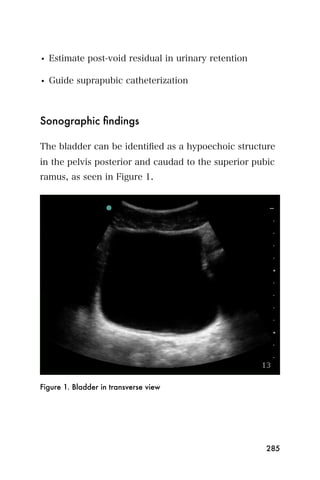 • Estimate post-void residual in urinary retention

• Guide suprapubic catheterization



Sonographic ﬁndings

The bladder can be identiﬁed as a hypoechoic structure
in the pelvis posterior and caudad to the superior pubic
ramus, as seen in Figure 1.




Figure 1. Bladder in transverse view




                                                     285
 