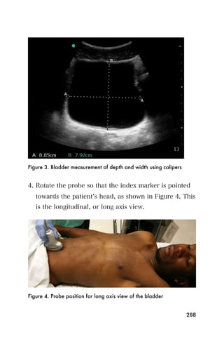 Figure 3. Bladder measurement of depth and width using calipers


4. Rotate the probe so that the index marker is pointed
   towards the patient s head, as shown in Figure 4. This
   is the longitudinal, or long axis view.




Figure 4. Probe position for long axis view of the bladder


                                                                  288
 