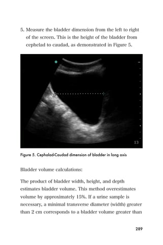 5. Measure the bladder dimension from the left to right
   of the screen. This is the height of the bladder from
   cephelad to caudad, as demonstrated in Figure 5.




Figure 5. Cephalad-Caudad dimension of bladder in long axis



Bladder volume calculations:

The product of bladder width, height, and depth
estimates bladder volume. This method overestimates
volume by approximately 15%. If a urine sample is
necessary, a minimal transverse diameter (width) greater
than 2 cm corresponds to a bladder volume greater than


                                                              289
 