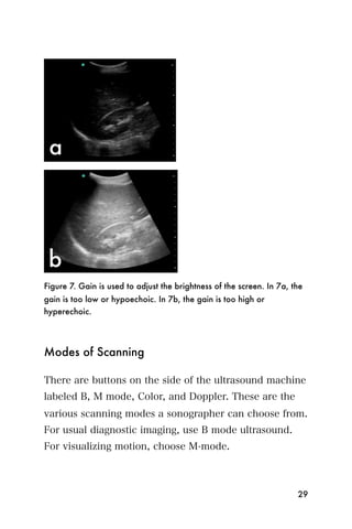 Figure 7. Gain is used to adjust the brightness of the screen. In 7a, the
gain is too low or hypoechoic. In 7b, the gain is too high or
hyperechoic.




Modes of Scanning

There are buttons on the side of the ultrasound machine
labeled B, M mode, Color, and Doppler. These are the
various scanning modes a sonographer can choose from.
For usual diagnostic imaging, use B mode ultrasound.
For visualizing motion, choose M-mode.



                                                                       29
 