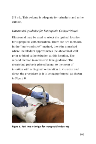 2-3 mL. This volume is adequate for urinalysis and urine
culture.


Ultrasound-guidance for Suprapubic Catheterization

Ultrasound may be used to select the optimal location
for suprapubic catheterization. There are two methods.
In the mark-and-stick method, the skin is marked
where the bladder approximates the abdominal wall
prior to blind catheterization at this location. The
second method involves real time guidance. The
ultrasound probe is placed lateral to the point of
insertion with a diagonal orientation to visualize and
direct the procedure as it is being performed, as shown
in Figure 6.




Figure 6. Real time technique for suprapubic bladder tap


                                                           290
 
