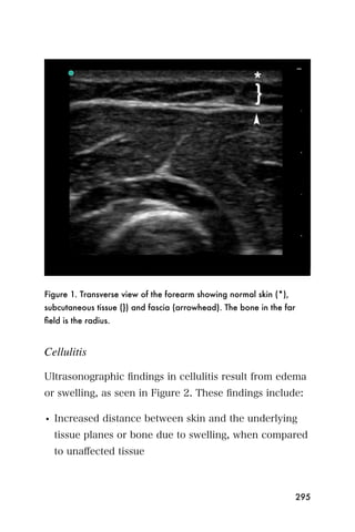 Figure 1. Transverse view of the forearm showing normal skin (*),
subcutaneous tissue (}) and fascia (arrowhead). The bone in the far
ﬁeld is the radius.


Cellulitis

Ultrasonographic ﬁndings in cellulitis result from edema
or swelling, as seen in Figure 2. These ﬁndings include:

• Increased distance between skin and the underlying
  tissue planes or bone due to swelling, when compared
  to unaﬀected tissue



                                                                      295
 
