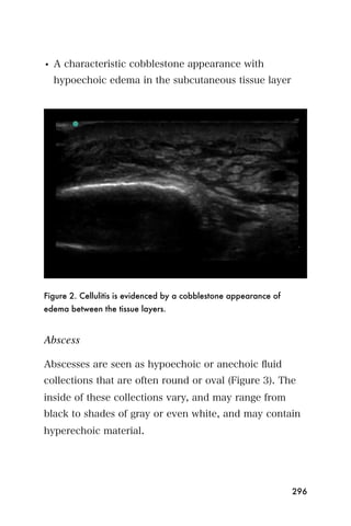 • A characteristic cobblestone appearance with
  hypoechoic edema in the subcutaneous tissue layer




Figure 2. Cellulitis is evidenced by a cobblestone appearance of
edema between the tissue layers.


Abscess

Abscesses are seen as hypoechoic or anechoic ﬂuid
collections that are often round or oval (Figure 3). The
inside of these collections vary, and may range from
black to shades of gray or even white, and may contain
hyperechoic material.




                                                                   296
 