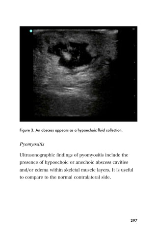 Figure 3. An abscess appears as a hypoechoic ﬂuid collection.


Pyomyositis

Ultrasonographic ﬁndings of pyomyositis include the
presence of hypoechoic or anechoic abscess cavities
and/or edema within skeletal muscle layers. It is useful
to compare to the normal contralateral side.




                                                                297
 