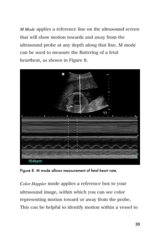 M Mode applies a reference line on the ultrasound screen
that will show motion towards and away from the
ultrasound probe at any depth along that line. M mode
can be used to measure the ﬂuttering of a fetal
heartbeat, as shown in Figure 8.




Figure 8. M mode allows measurement of fetal heart rate.


Color Doppler mode applies a reference box to your
ultrasound image, within which you can see color
representing motion toward or away from the probe.
This can be helpful to identify motion within a vessel to


                                                           30
 