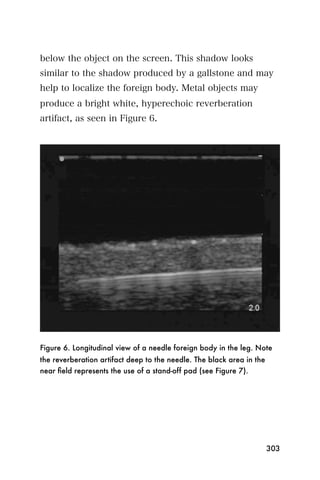 below the object on the screen. This shadow looks
similar to the shadow produced by a gallstone and may
help to localize the foreign body. Metal objects may
produce a bright white, hyperechoic reverberation
artifact, as seen in Figure 6.




Figure 6. Longitudinal view of a needle foreign body in the leg. Note
the reverberation artifact deep to the needle. The black area in the
near ﬁeld represents the use of a stand-off pad (see Figure 7).




                                                                       303
 