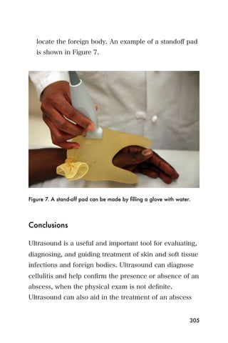 locate the foreign body. An example of a standoﬀ pad
   is shown in Figure 7.




Figure 7. A stand-off pad can be made by ﬁlling a glove with water.




Conclusions

Ultrasound is a useful and important tool for evaluating,
diagnosing, and guiding treatment of skin and soft tissue
infections and foreign bodies. Ultrasound can diagnose
cellulitis and help conﬁrm the presence or absence of an
abscess, when the physical exam is not deﬁnite.
Ultrasound can also aid in the treatment of an abscess


                                                                  305
 